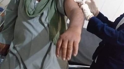 تطعيم مرضى الغسيل الكلوي ضد فيروس كورونا في سوهاج