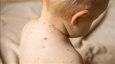 الصحة تكشف حقيقة انتشار مرض الحصبة بين الأطفال بمختلف محافظات الجمهورية