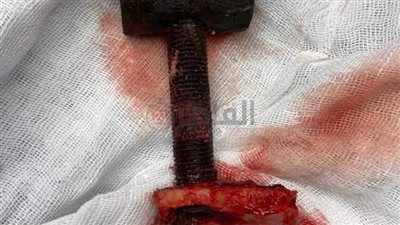 استخراج مسمار سيارة نقل من جمجمة مريض بمستشفى أبو خليفة في الإسماعيلية (صور)
