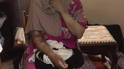 شيماء بعد تعذيبها على يد زوجها بالإسكندرية: أدمن المخدرات وأجبرنا على التسول