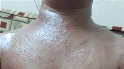 القناديل تغزو شواطئ العريش من جديد.. وتصيب الأهالي بلسعات حارقة