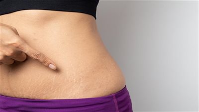 الاسترتش مارك حقائق لا تعرفها عن علامات التمدد
