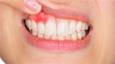 أبرزها فقر الدم والتهاب اللثة.. أعراض نقص فيتامين سي