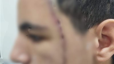 بمعاونة شقيقيه.. طالب يعتدي على زميله بكاتر محدثًا إصابته بقطع في الوجه بـ التجمع الأول │ صور