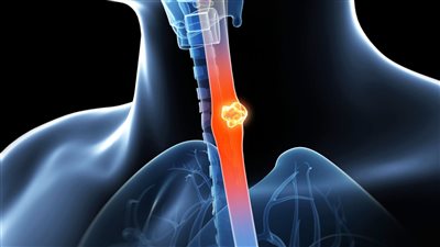 يصيب الرجال أكثر من النساء.. تعرف على سرطان المريء وأعراضه وعلاجه