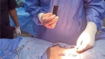 استخراج هاتف محمول من معدة شاب بمستشفى بنها الجامعي │ بث مباشر