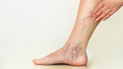 تُسبب الدوالي.. تعرف على مخاطر الجلوس بوضع ساق على أخرى 